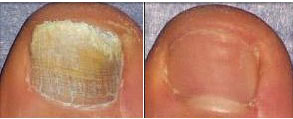 Toe Nail Fungus Before/After Laser Treatment